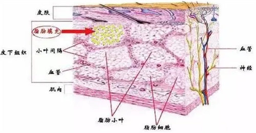 脂肪填充图