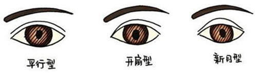 平行型、開(kāi)扇型、新月型雙眼皮示意圖 平行型、開(kāi)扇型、新月型雙眼皮示意圖