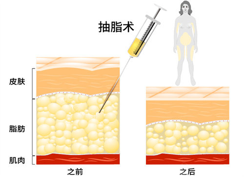 抽脂術(shù)過程說明圖 抽脂術(shù)過程說明圖
