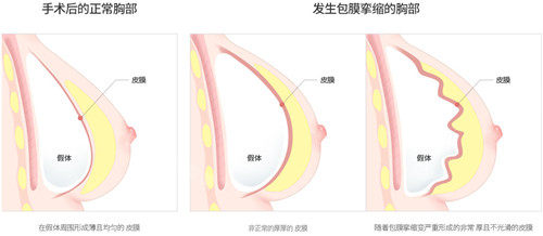 挛缩的胸部手术图