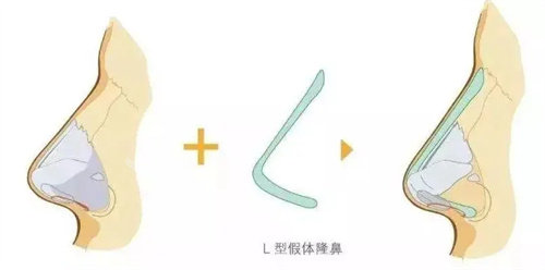 L型假體動(dòng)畫(huà)展示圖 L型假體動(dòng)畫(huà)展示圖
