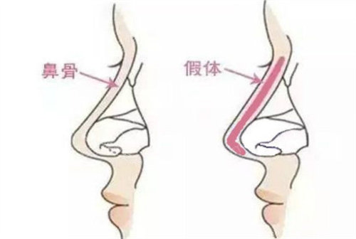 隆鼻結(jié)構(gòu)展示圖