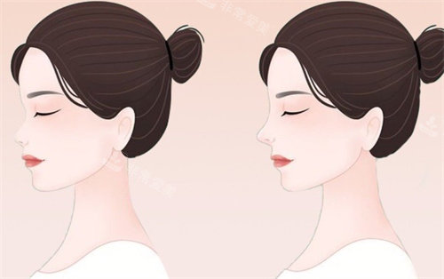 鼻梁高低對(duì)比圖 鼻梁高低對(duì)比圖