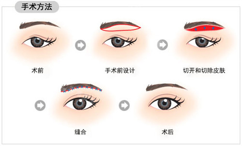 切眉手術(shù)方法圖