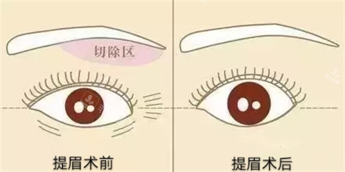 提眉手術(shù)前后對(duì)比圖