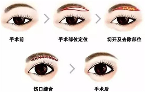 切眉手術(shù)過程圖