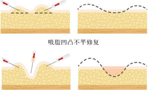 吸脂凹凸不平修復(fù)圖片