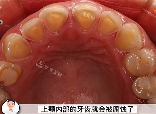 上顎牙齒被腐蝕 上顎牙齒被腐蝕