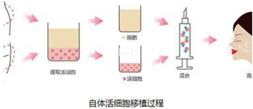 面部脂肪填充图