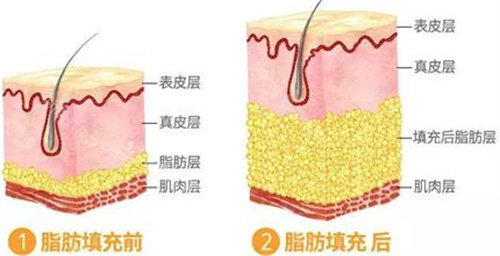 脂肪填充前后图