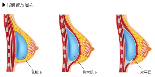 深圳福雅整形隆胸好吗？胸型自然饱满备受整友好评！