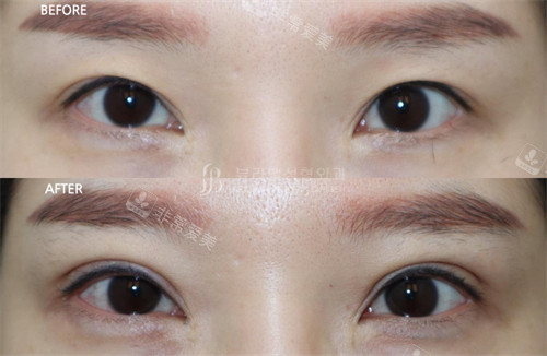 韩国Beulibal整形外科双眼皮术前术后对比照