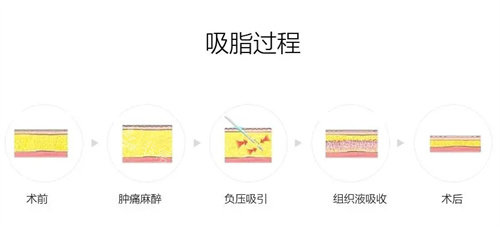 吸脂過(guò)程圖