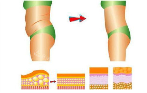 吸脂前后对比图