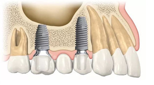 多颗种植牙侧面展示图