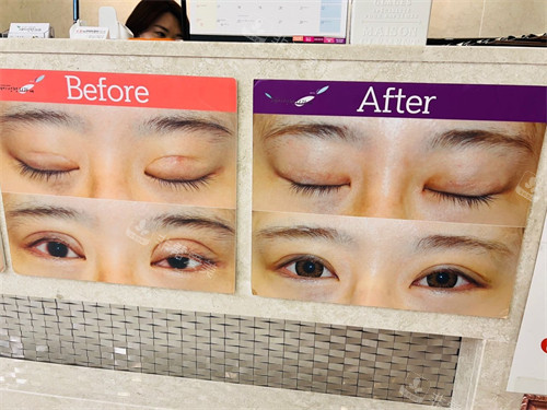 韩国世美整形外科眼修复对比图展示