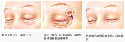 下眼瞼手術(shù)圖