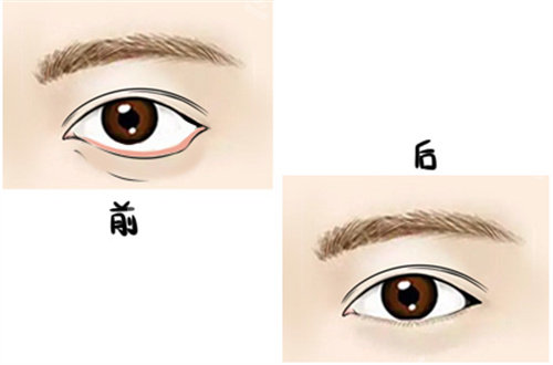 下眼瞼外翻示意圖