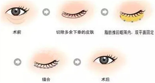 下眼瞼外翻手術(shù)圖