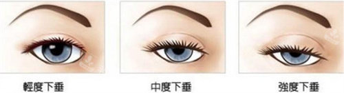 下眼瞼下垂圖片