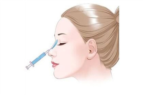 注射隆鼻手术示意图