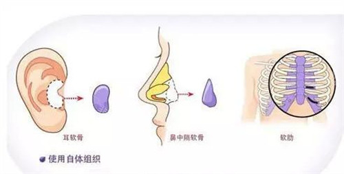 自體肋軟骨隆鼻示意圖 自體肋軟骨隆鼻示意圖