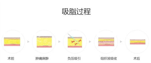 吸脂过程图