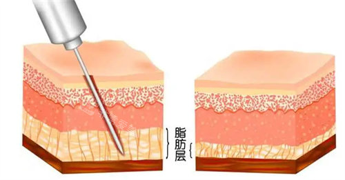 抽脂前后脂肪層變化圖 抽脂前后脂肪層變化圖
