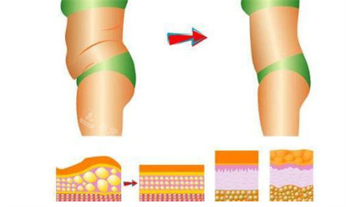腰腹环吸前后对比图