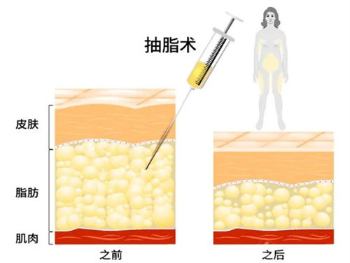 抽脂前后对比图