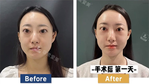 韓國必當(dāng)歸整形突眼矯正對(duì)比圖 韓國必當(dāng)歸整形突眼矯正對(duì)比圖