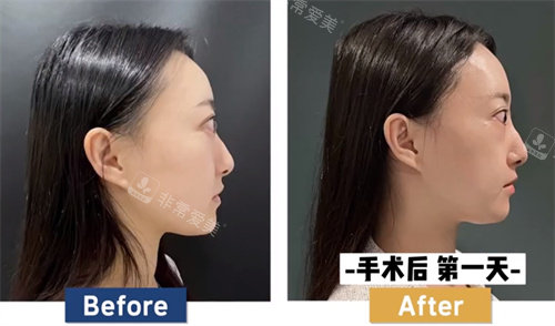 韓國必當(dāng)歸整形突眼矯正側(cè)面圖 韓國必當(dāng)歸整形突眼矯正側(cè)面圖
