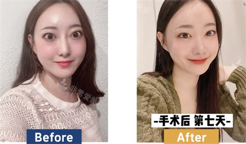 韓國必當(dāng)歸整形突眼矯正術(shù)后圖 韓國必當(dāng)歸整形突眼矯正術(shù)后圖