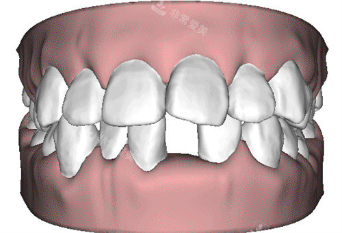牙齿动画图
