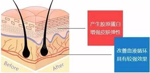 面部提升埋线图