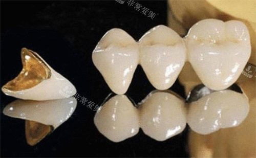 烤瓷牙示意圖 烤瓷牙示意圖