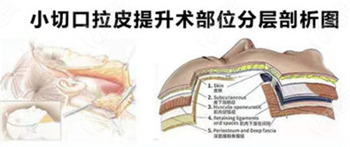小切口拉皮图