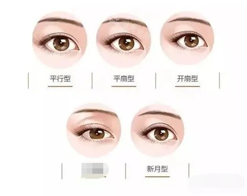 眼整形示意图 眼整形示意图