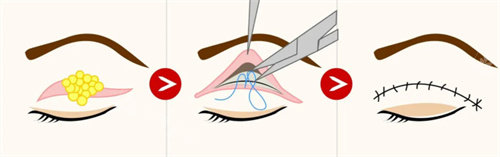 全切双眼皮流程图