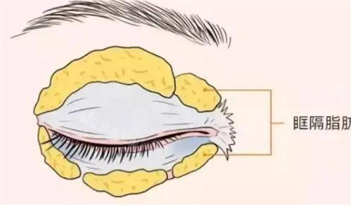 眶隔脂肪釋放動畫圖