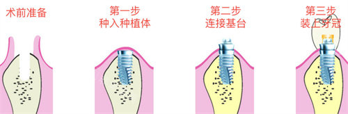 種植牙手術(shù)流程圖 種植牙手術(shù)流程圖