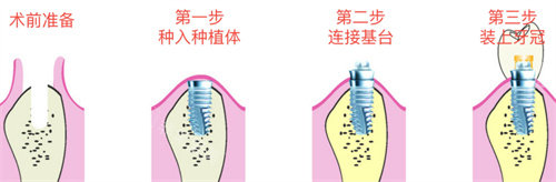 種植牙手術(shù)流程圖