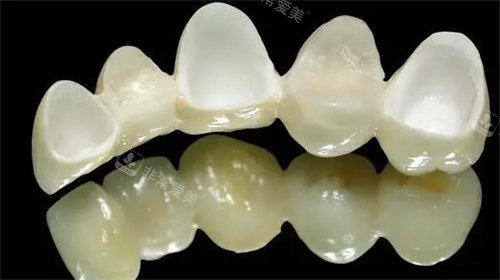 全瓷連橋冠實(shí)例圖 全瓷連橋冠實(shí)例圖