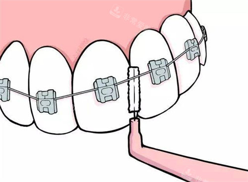 金属牙套清洁动画图