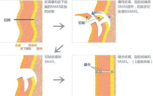 拉皮手术操作图