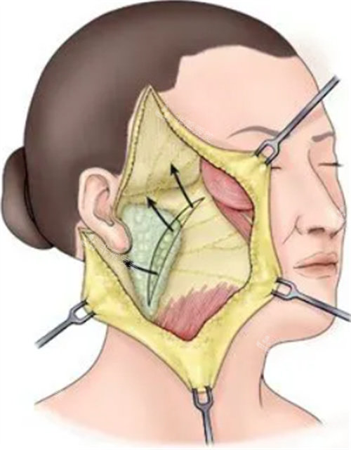 拉皮手术示意图
