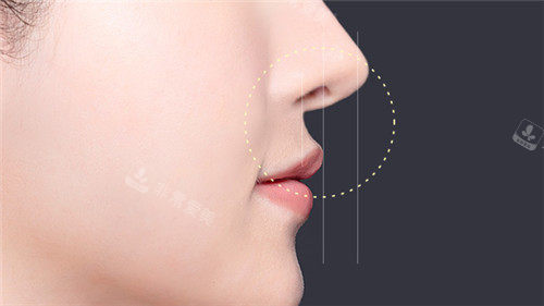 uverse鼻部整形特點(diǎn) uverse鼻部整形特點(diǎn)