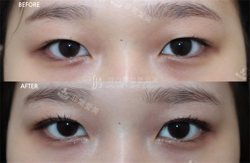 韩国Beulibal整形外科双眼皮术前术后对比图