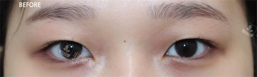 韩国Beulibal整形外科双眼皮术前图