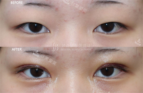 韩国Beulibal整形外科全切双眼皮术前术后对比图